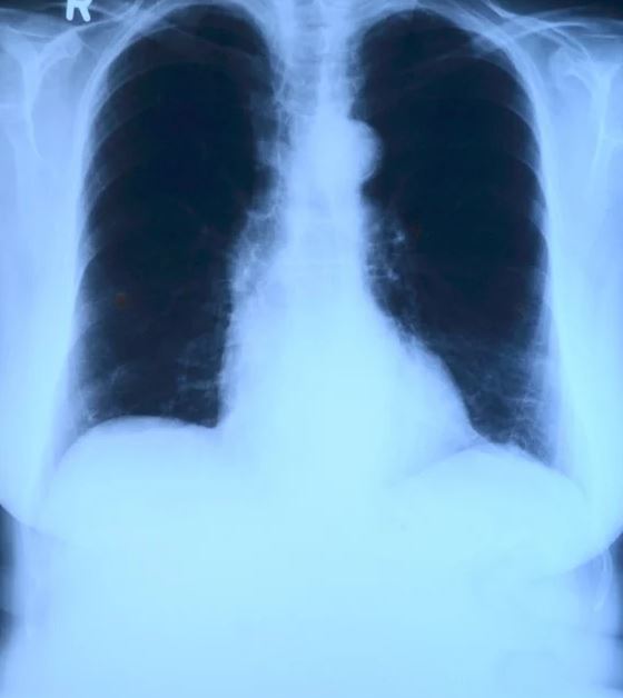 KAKO SE LEČI OVA STRAŠNA BOLEST: Danas je Svetski dan borbe protiv opstruktivne bolesti pluća
