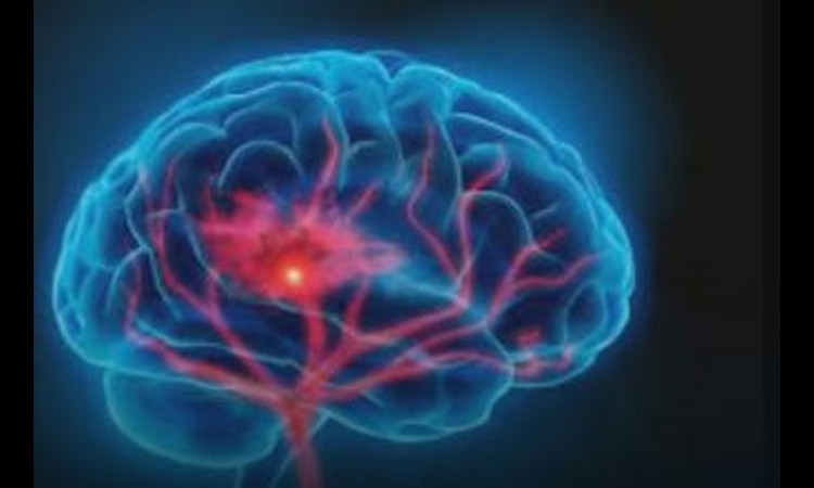 NEUROLOG UPOZORAVA: Ovo su prvi znaci moždanog udara!