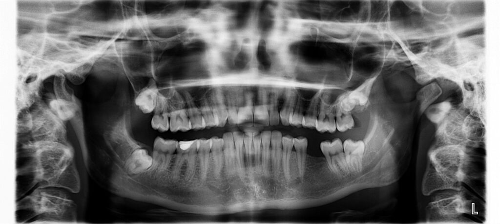 ZABORAVITE NA PROTEZU: Zahvaljujući novom leku moći da nam izrastu i treći zubi?